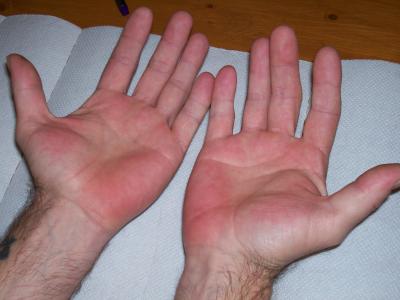 heat rash on hands. When you people say red hands,